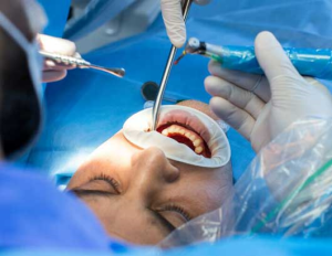 Diş Eti Greftleme Ameliyatı Hakkında