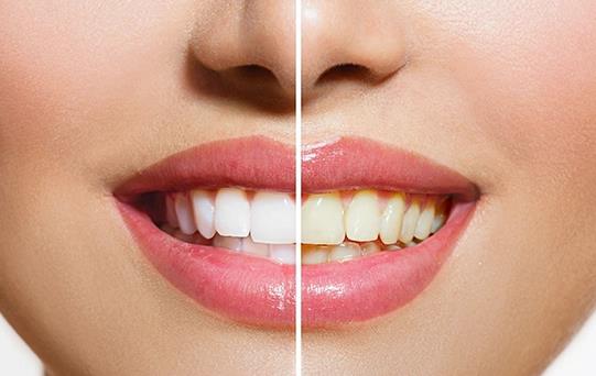 Diş Beyazlatma Sağlıklı Mıdır?
