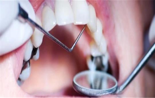 Diş Çürümesinin Belirtileri ve Yaygın Nedenleri