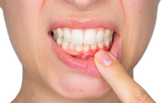 Diş Kökü İltihabı Belirtileri Nelerdir? Nasıl Geçer?