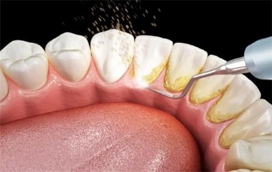 Diş Taşı Temizliği Nasıl Yapılır?