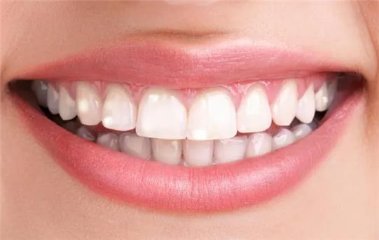 Dişlerdeki Beyaz Lekeler Neden Olur?