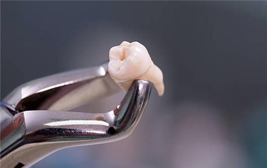 Gömülü Diş Nedir, Ameliyatı Zor Mu?
