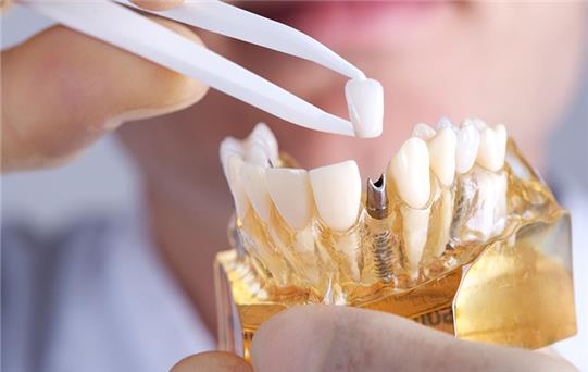 Protetik Diş Tedavisi Nedir, Kimlere Uygulanır?
