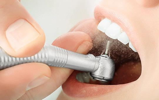 Restoratif Diş Tedavisi Nedir, Nasıl Yapılır?