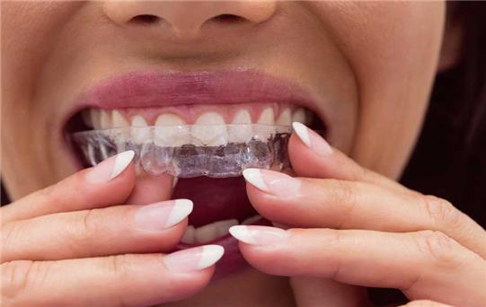 Şeffaf Plaklarla Gülümsemenizi Yenileyin: Invisalign Tedavisi