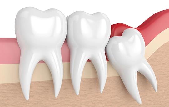 Yirmilik diş ağrısı neden olur, ne iyi gelir?